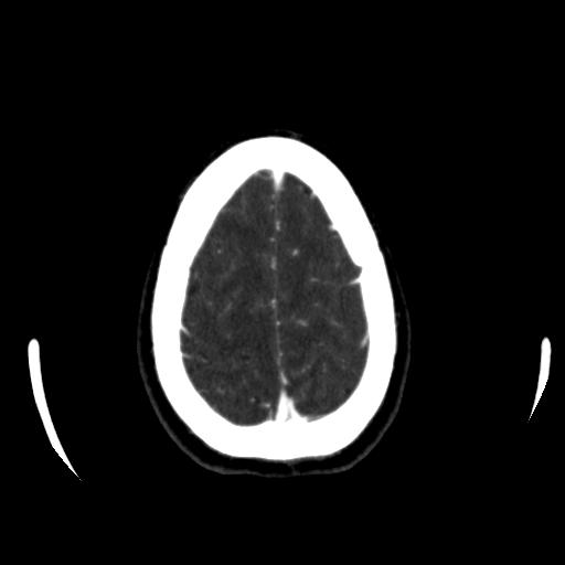 File:Anterior communicating artery aneurysm (Radiopaedia 16633-16335 A 39).jpg