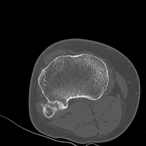 File:Anterior cruciate ligament avulsion fracture (Radiopaedia 58939-66194 Axial bone window 25).jpg