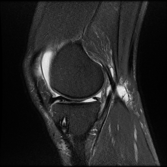 File:Anterior cruciate ligament graft tear and bucket-handle tear of medial meniscus (Radiopaedia 75867-87255 Sagittal PD fat sat 8).jpg
