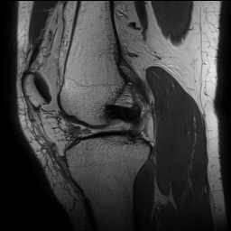 Anterior cruciate ligament rupture with Segond fracture (Radiopaedia 69043-78806 Sagittal PD 82).jpg