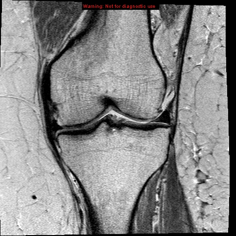 File:Anterior cruciate ligament tear (Radiopaedia 12329-12612 Coronal PD 11).jpg