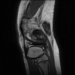Anterior cruciate ligament tear - pediatric (Radiopaedia 62152-70260 Sagittal PD 149).jpg