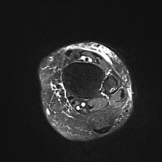 File:Anterior talofibular ligament injury - rupture with soft-tissue impingement (Radiopaedia 38765-40928 Axial T2 fat sat 7).jpg