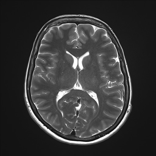 File:Anterior temporal encephalocele (Radiopaedia 82624-96808 Axial T2 21).jpg