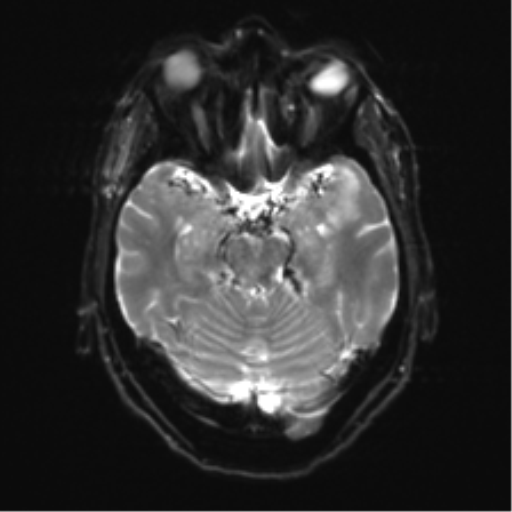 Anterior temporal pole cysts (Radiopaedia 46629-51102 Axial DWI 10).png