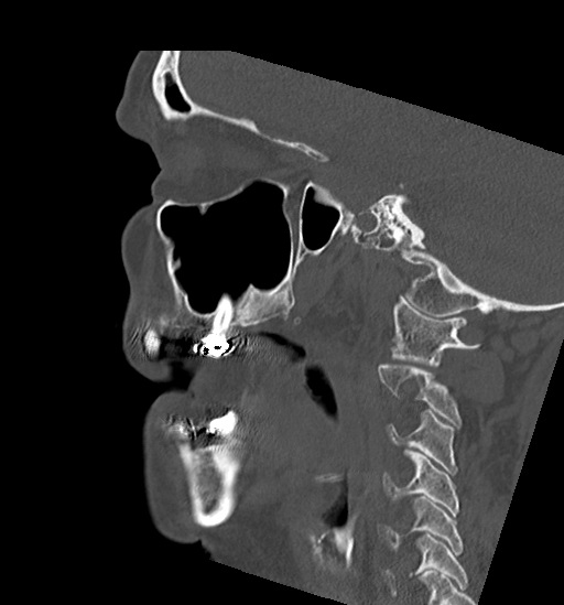 Anterior temporomandibular joint dislocation (Radiopaedia 59430-66784 B 22).jpg