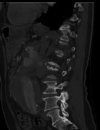 File:Anterior vertebral scalloping (abdominal aortic aneurysm) (Radiopaedia 66744-76067 Sagittal bone window 59).jpg