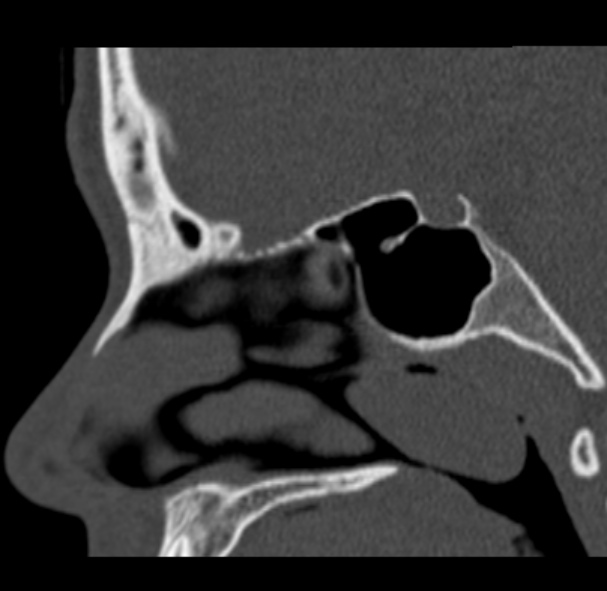 Antrochoanal polyp (Radiopaedia 33984-35202 Sagittal bone window 39).jpg