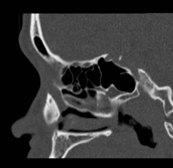 Antrochoanal polyp (Radiopaedia 33984-35202 Sagittal bone window 51).jpg