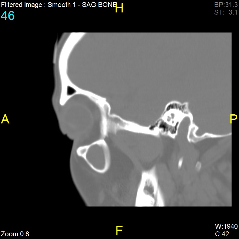 Antrochoanal polyp (Radiopaedia 65101-74094 Sagittal bone window 46).jpg