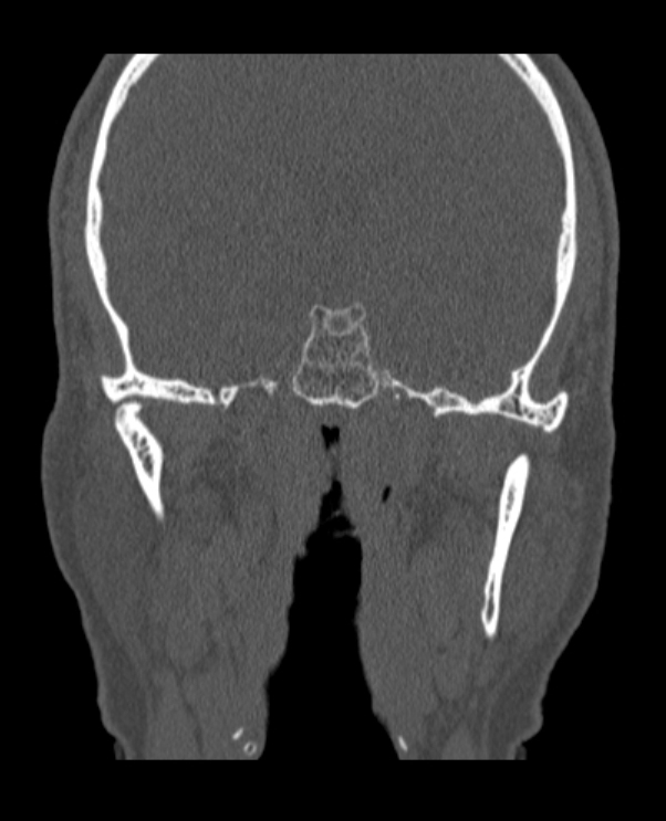 Antrochoanal polyp (Radiopaedia 79011-92169 Coronal bone window 3).jpg
