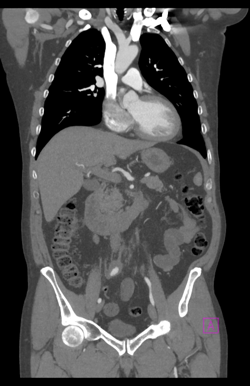 Aortectomy and axillary-bifemoral bypass (Radiopaedia 28303-28545 C 42).jpg