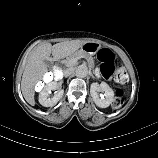 Aortic aneurysm and Lemmel syndrome (Radiopaedia 86499-102554 Axial C+ delayed 27).jpg