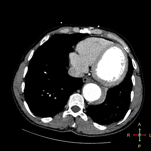 File:Aortic aneurysm and penetrating ulcer (Radiopaedia 23590-23704 A 24).jpg