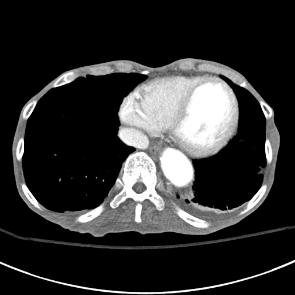 File:Aortic aneurysm with spinal destruction (Radiopaedia 42301-45410 A 3).jpg