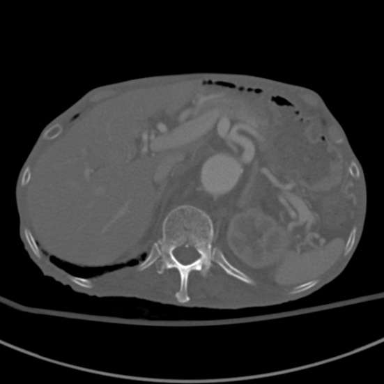 Aortic aneurysm with spinal destruction (Radiopaedia 42301-45410 Axial bone window 23).jpg