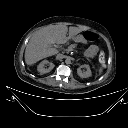 Aortic arch aneurysm (Radiopaedia 84109-99365 Axial non-contrast 306).jpg
