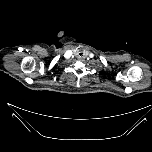File:Aortic arch aneurysm (Radiopaedia 84109-99365 B 24).jpg