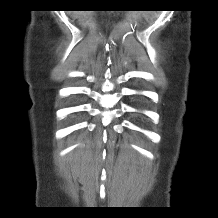 Aortic arch graft infection (FDG PET-CT) (Radiopaedia 71975-82437 Coronal 55).jpg