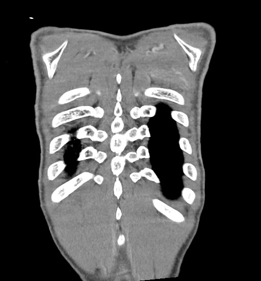 Aortic coarctation with aneurysm (Radiopaedia 74818-85828 C 109).jpg