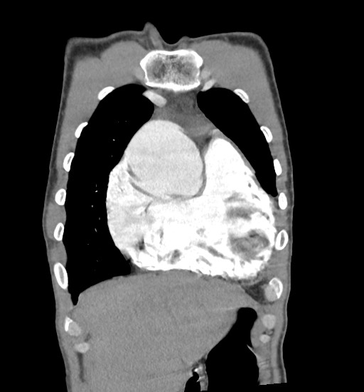 File:Aortic coarctation with aneurysm (Radiopaedia 74818-85828 C 24).jpg