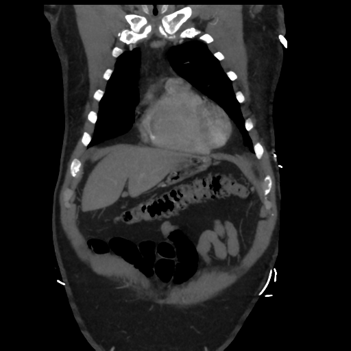File:Aortic dissection- Stanford A (Radiopaedia 37759-39664 Coronal C+ delayed 6).png