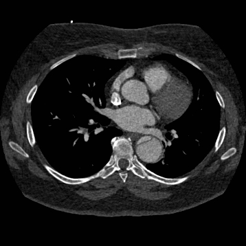 File:Aortic dissection (Radiopaedia 57969-64959 A 169).jpg
