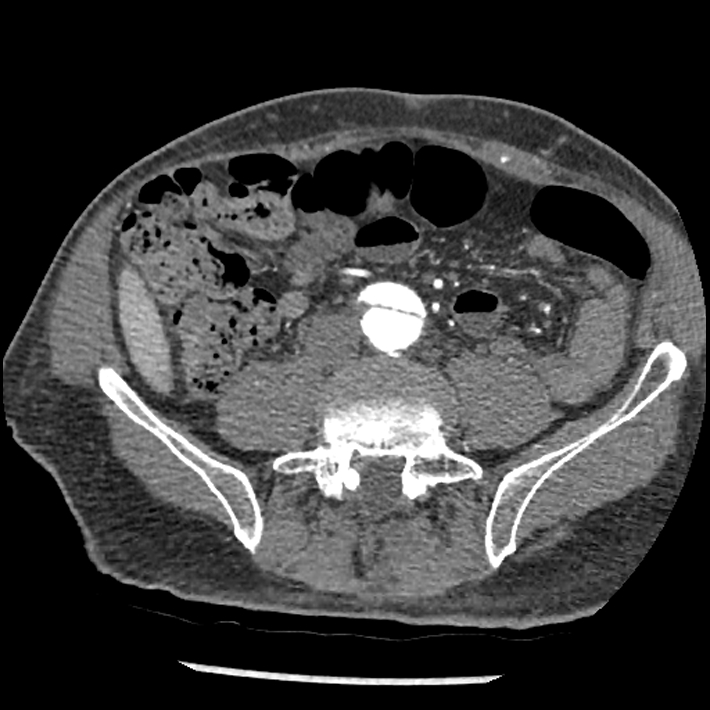 Aortic dissection - DeBakey Type I-Stanford A (Radiopaedia 79863-93115 A 63).jpg