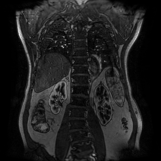 File:Aortic dissection - Stanford A - DeBakey I (Radiopaedia 23469-23551 D 183).jpg