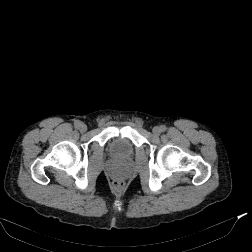 Aortic dissection - Stanford type A (Radiopaedia 83418-98500 Axial non-contrast 92).jpg