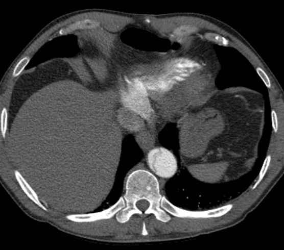 Aortic dissection - Stanford type B (Radiopaedia 73648-84437 A 93).jpg