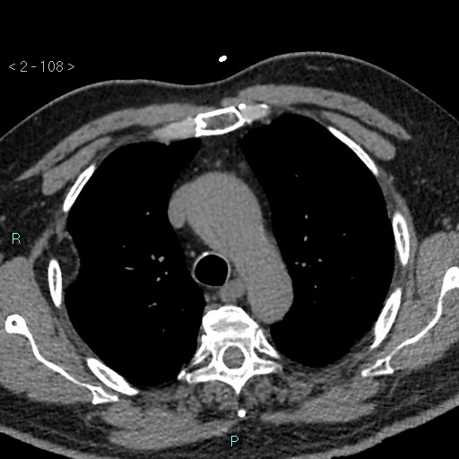 Aortic intramural hematoma (Radiopaedia 48463-53380 Axial non-contrast 48).jpg
