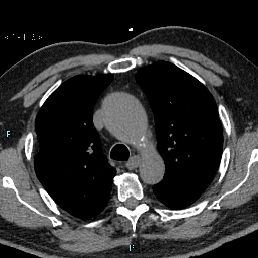 Aortic intramural hematoma (Radiopaedia 48463-53380 Axial non-contrast 52).jpg