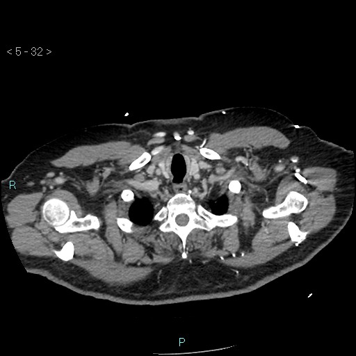 Aortic intramural hematoma (Radiopaedia 48463-53380 C 16).jpg