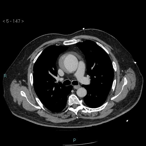 Aortic intramural hematoma (Radiopaedia 48463-53380 C 67).jpg