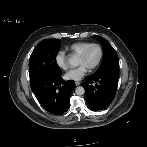Aortic intramural hematoma (Radiopaedia 48463-53380 C 99).jpg