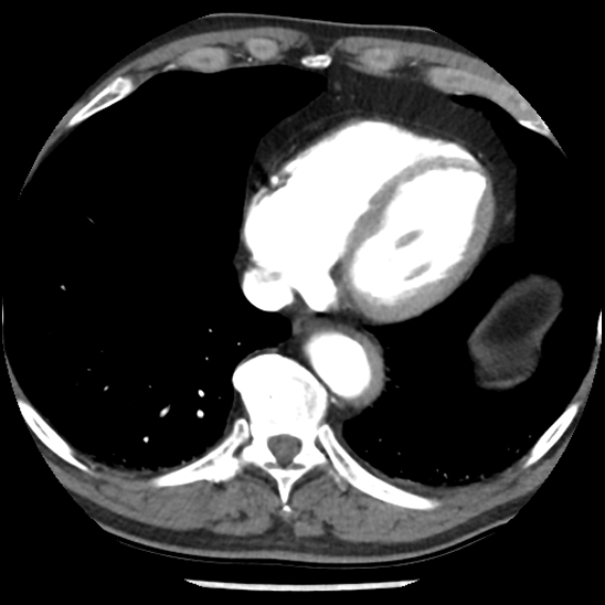Aortic intramural hematoma (type B) (Radiopaedia 79323-92387 B 41).jpg
