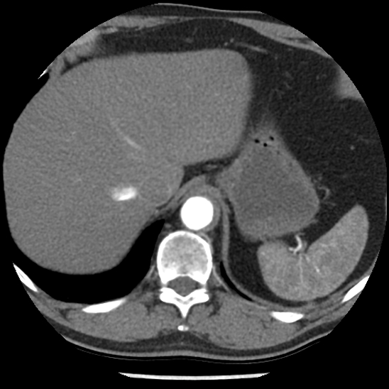 File:Aortic intramural hematoma (type B) (Radiopaedia 79323-92387 B 50).jpg