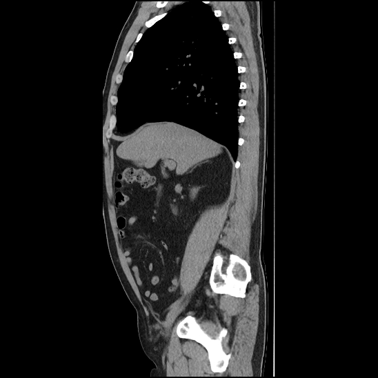 File:Aortic intramural hematoma (type B) (Radiopaedia 79323-92387 G 14).jpg