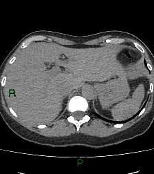 Aortic valve endocarditis (Radiopaedia 87209-103485 Axial non-contrast 91).jpg