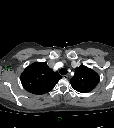 Aortic valve endocarditis (Radiopaedia 87209-103485 C 17).jpg