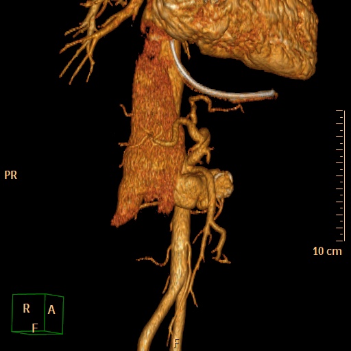 File:Aorto-left renal vein fistula (Radiopaedia 45534-49628 D 11).jpg