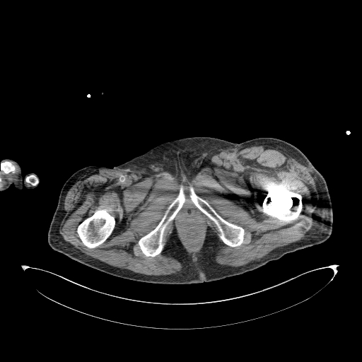 Aortoduodenal fistula (Radiopaedia 75286-86415 Axial non-contrast 82).jpg