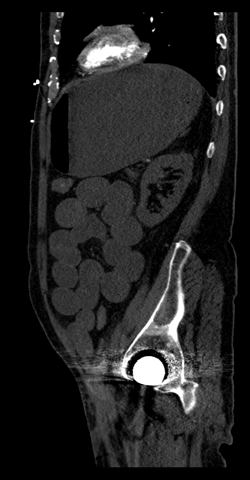 Aortoduodenal fistula (Radiopaedia 75286-86415 F 2).jpg
