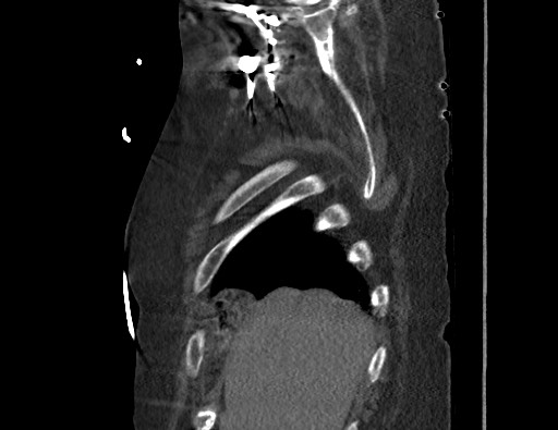 Aortoesophageal fistula with endovascular repair (Radiopaedia 73781-84592 Sagittal C+ CTPA 13).jpg