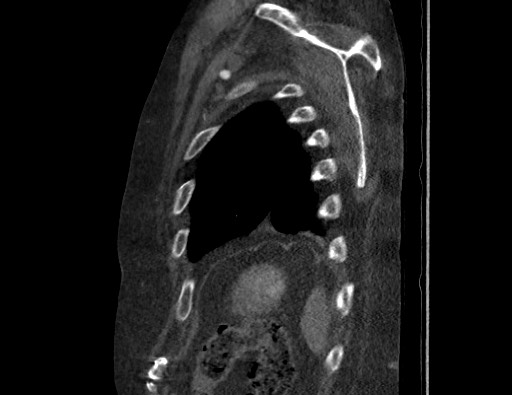 Aortoesophageal fistula with endovascular repair (Radiopaedia 73781-84592 Sagittal C+ CTPA 176).jpg