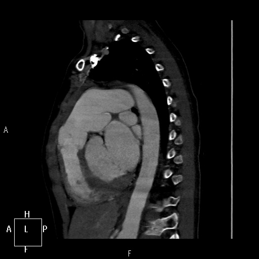 File:Aortopulmonary septal defect (Radiopaedia 41990-45013 Sagittal C+ CTPA 19).jpg