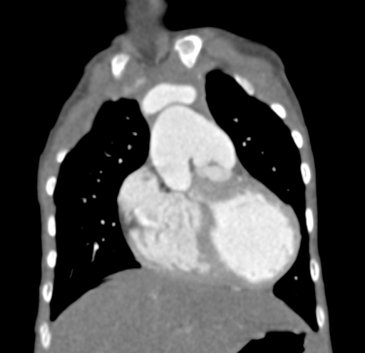 File:Aortopulmonary window, interrupted aortic arch and large PDA giving the descending aorta (Radiopaedia 35573-37074 D 17).jpg