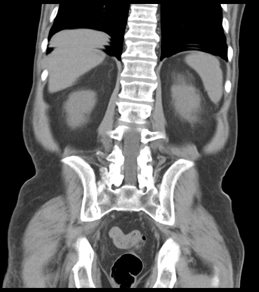 File:Appendiceal abscesses (Radiopaedia 50999-56542 Coronal non-contrast 43).png