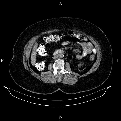 File:Appendiceal mucocele (Radiopaedia 86415-102460 Axial non-contrast 28).jpg